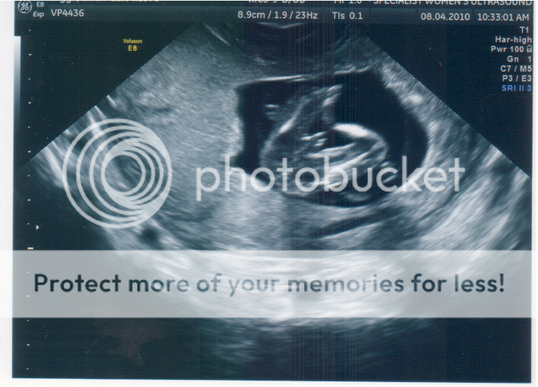Can pregnancy dating scans be wrong-in-Motueka